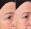 HYDROPEPTIDE - exfoliace a zesvětlení pleti Liquid Resurfacing 120 ml