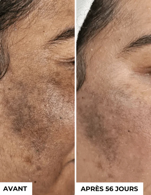 DERMEDEN koncentrát proti pigmentaci - Anti-Dark Spots 3 x 10 ml