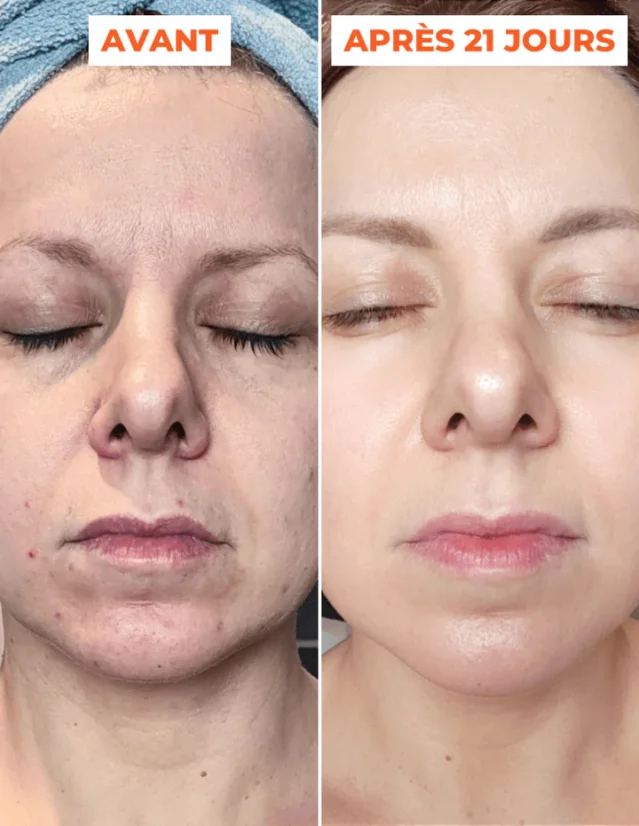 DERMEDEN domácí peeling - Advanced Peel 2 x 30 ml
