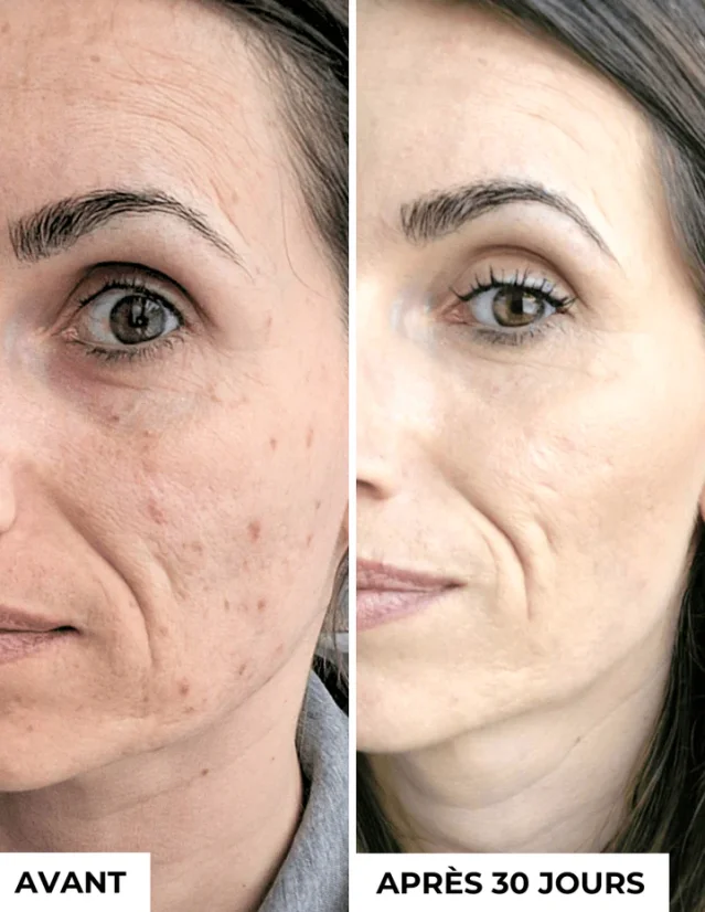 DERMEDEN koncentrát proti pigmentaci - Anti-Dark Spots 3 x 10 ml